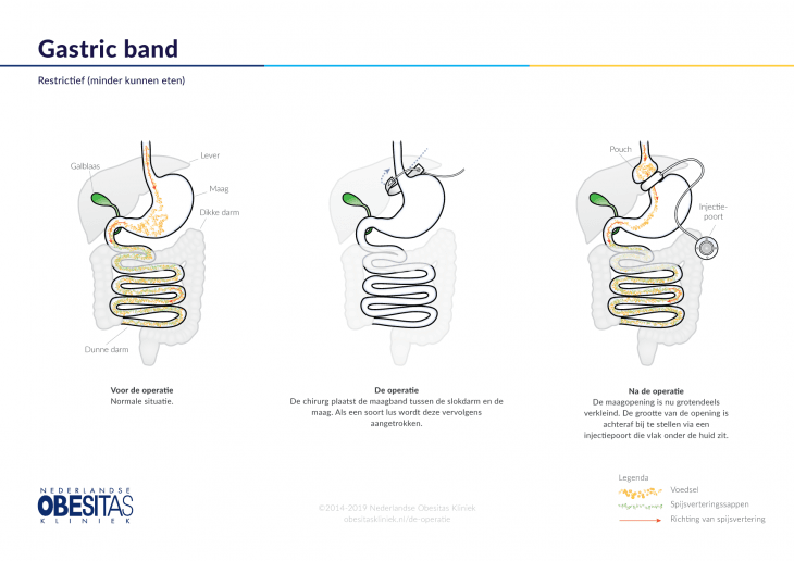 bariatrie gastric band.png